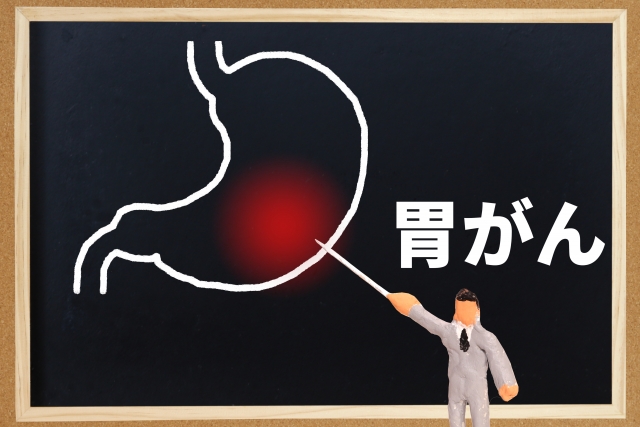 胃がんのイメージ